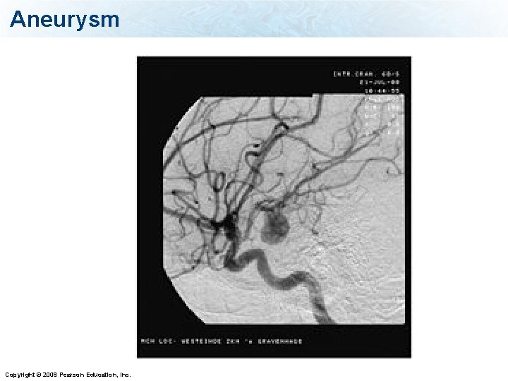 Aneurysm Copyright © 2009 Pearson Education, Inc. 