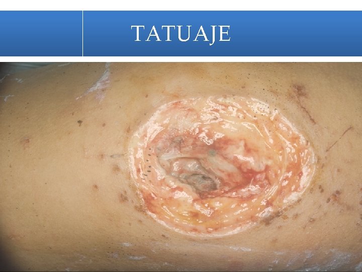 TATUAJE 