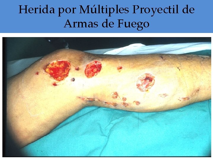 Herida por Múltiples Proyectil de Armas de Fuego 