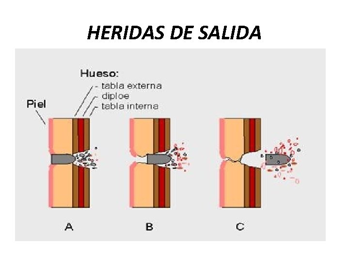 HERIDAS DE SALIDA 