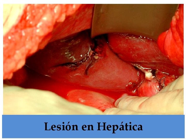 Lesión en Hepática 