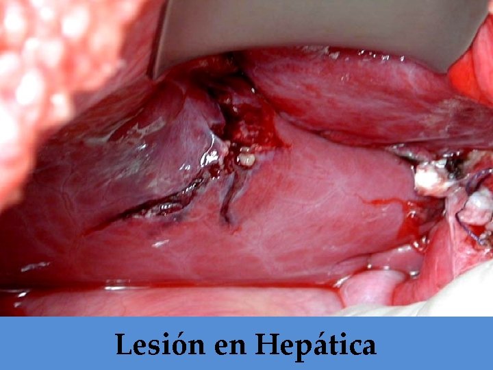 Lesión en Hepática 