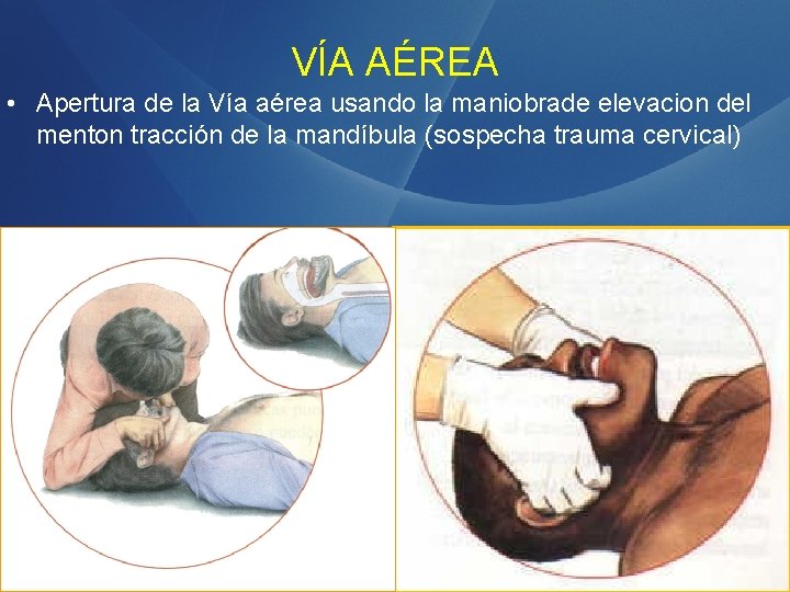 VÍA AÉREA • Apertura de la Vía aérea usando la maniobrade elevacion del menton