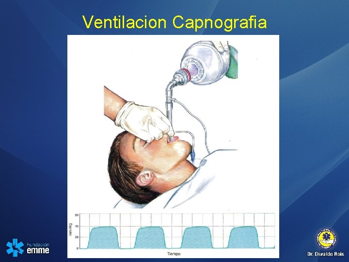 Ventilacion Capnografia 