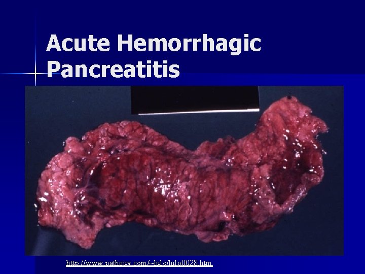 Acute Hemorrhagic Pancreatitis http: //www. pathguy. com/~lulo/lulo 0028. htm 