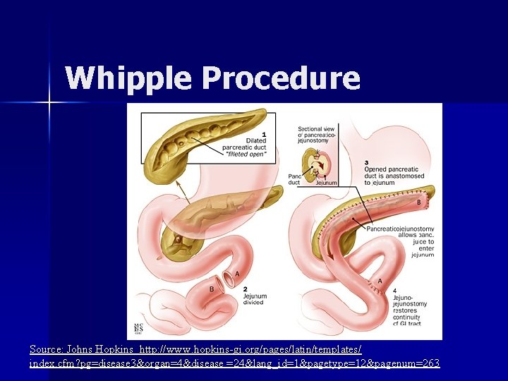Whipple Procedure Source: Johns Hopkins http: //www. hopkins-gi. org/pages/latin/templates/ index. cfm? pg=disease 3&organ=4&disease =24&lang_id=1&pagetype=12&pagenum=263