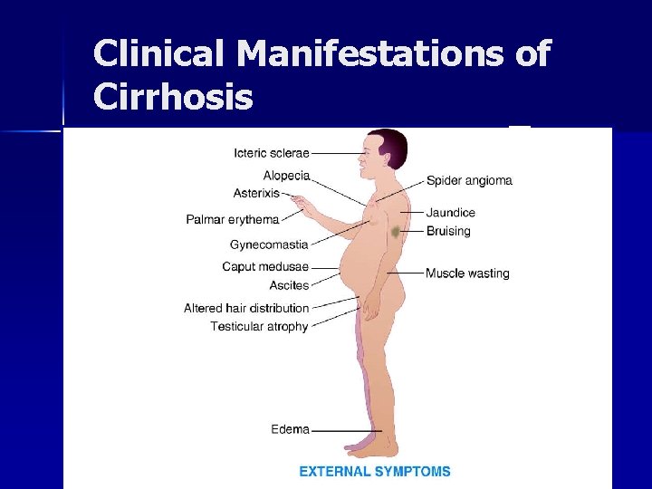 Clinical Manifestations of Cirrhosis © 2004, 2002 Elsevier Inc. All rights reserved. 