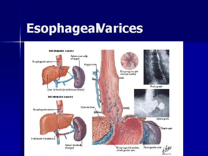 Esophageal. Varices 