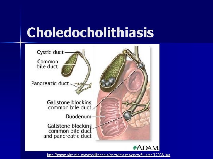 Choledocholithiasis http: //www. nlm. nih. gov/medlineplus/ency/images/ency/fullsize/17038. jpg 