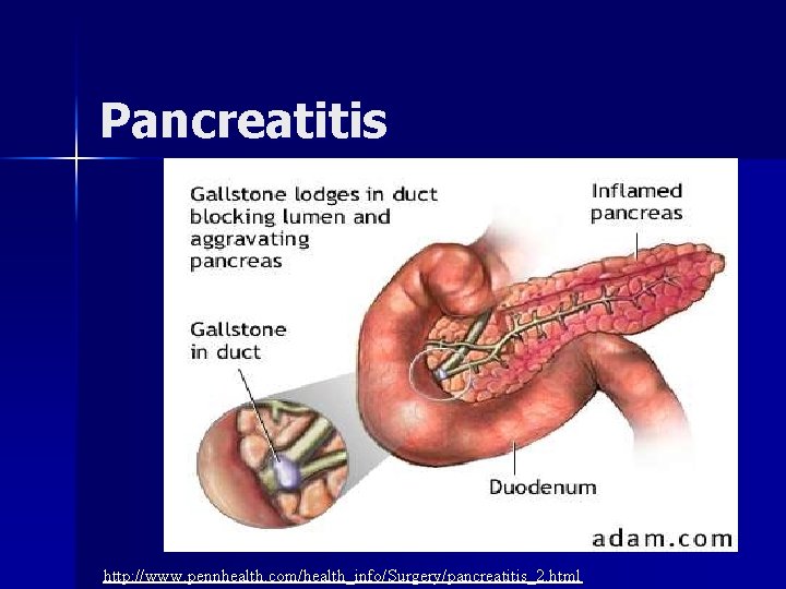 Pancreatitis http: //www. pennhealth. com/health_info/Surgery/pancreatitis_2. html 