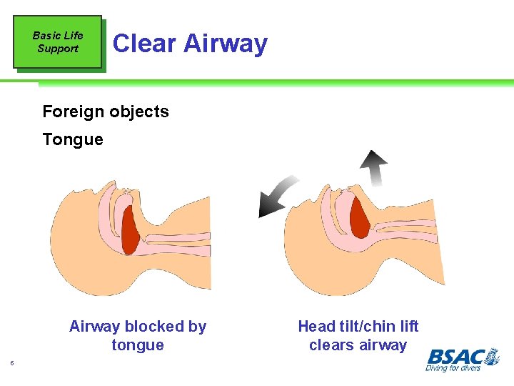 Basic Life Support Clear Airway Foreign objects Tongue Airway blocked by tongue 5 Head