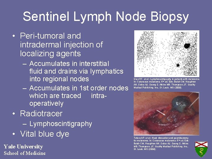 Sentinel Lymph Node Biopsy • Peri-tumoral and intradermal injection of localizing agents – Accumulates