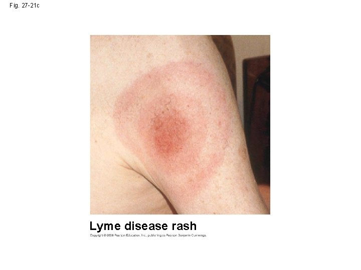 Fig. 27 -21 c Lyme disease rash 