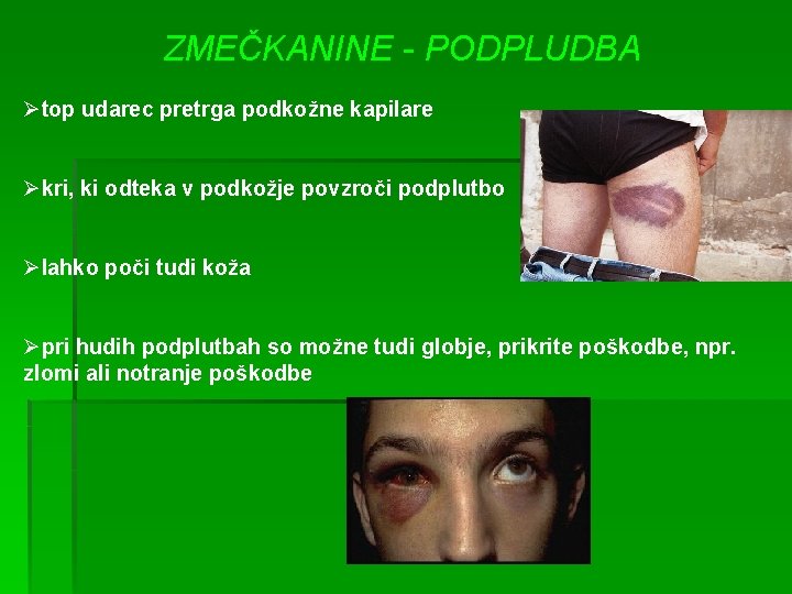 ZMEČKANINE - PODPLUDBA Øtop udarec pretrga podkožne kapilare Økri, ki odteka v podkožje povzroči