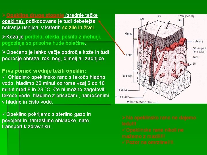 ØOpekline druge stopnje (srednje težke opekline): poškodovana je tudi debelejša notranja usnjica, v katerih