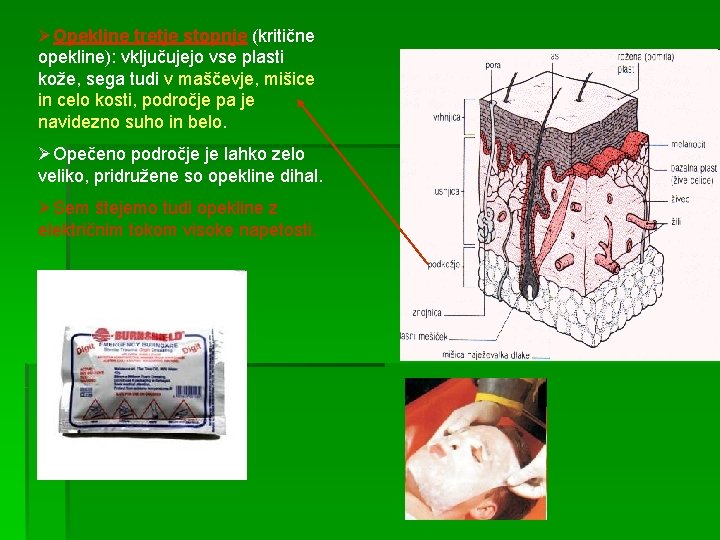 ØOpekline tretje stopnje (kritične opekline): vključujejo vse plasti kože, sega tudi v maščevje, mišice