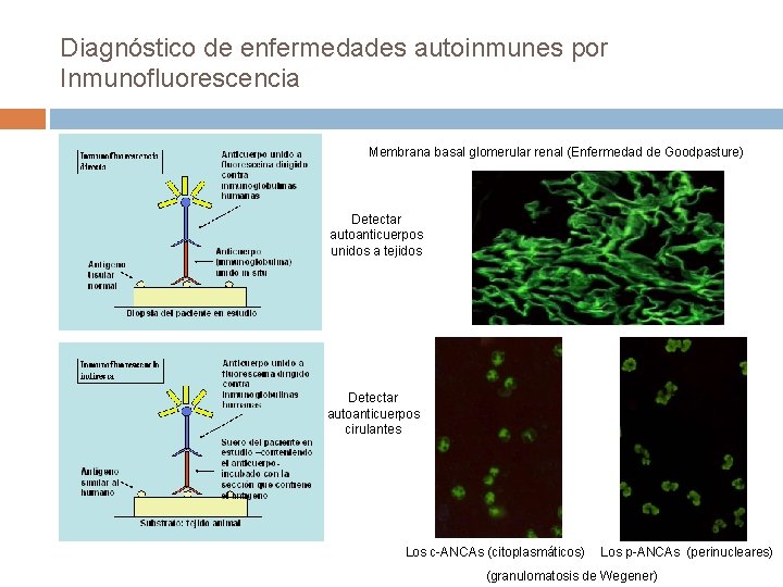 Diagnóstico de enfermedades autoinmunes por Inmunofluorescencia Membrana basal glomerular renal (Enfermedad de Goodpasture) Detectar