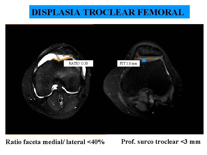 DISPLASIA TROCLEAR FEMORAL RATIO O. 30 Ratio faceta medial/ lateral <40% PST 1. 8