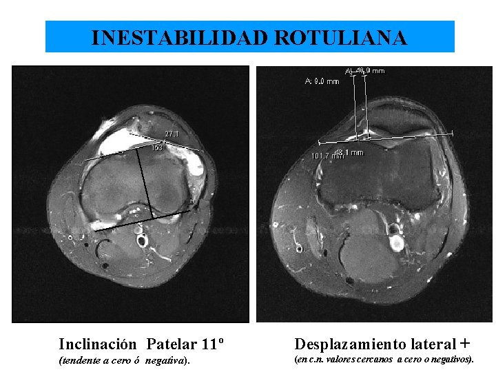 INESTABILIDAD ROTULIANA INESTABILIDAD Inclinación Patelar 11º Desplazamiento lateral + (tendente a cero ó negativa).