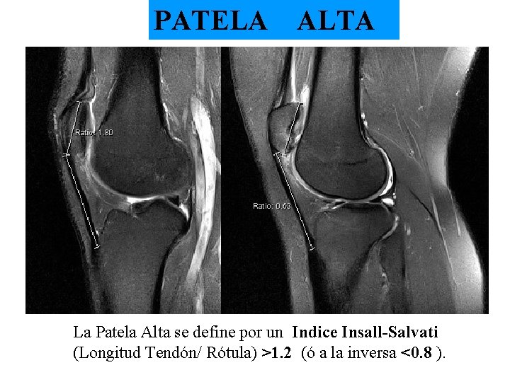 PATELA ALTA La Patela Alta se define por un Indice Insall-Salvati (Longitud Tendón/ Rótula)