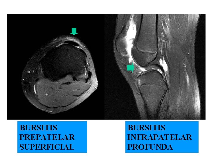 BURSITIS PREPATELAR SUPERFICIAL BURSITIS INFRAPATELAR PROFUNDA 