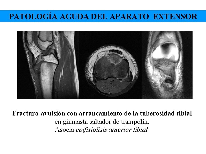 PATOLOGÍA AGUDA DEL APARATO EXTENSOR Fractura-avulsión con arrancamiento de la tuberosidad tibial en gimnasta