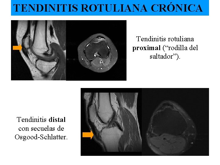 TENDINITIS ROTULIANA CRÓNICA Tendinitis rotuliana proximal (“rodilla del saltador”). Tendinitis distal con secuelas de