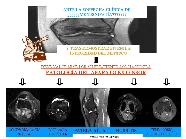 ANTE LA SOSPECHA CLÍNICA DE ¿¿¿¿¿¿MENISCOPATÍA? ? ? ? Y TRAS DEMOSTRAR EN RM