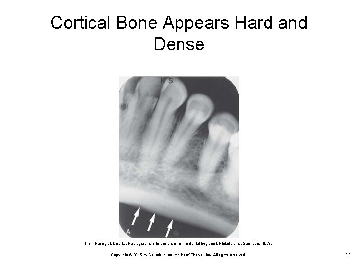 Cortical Bone Appears Hard and Dense From Haring JI, Lind LJ: Radiographic interpretation for