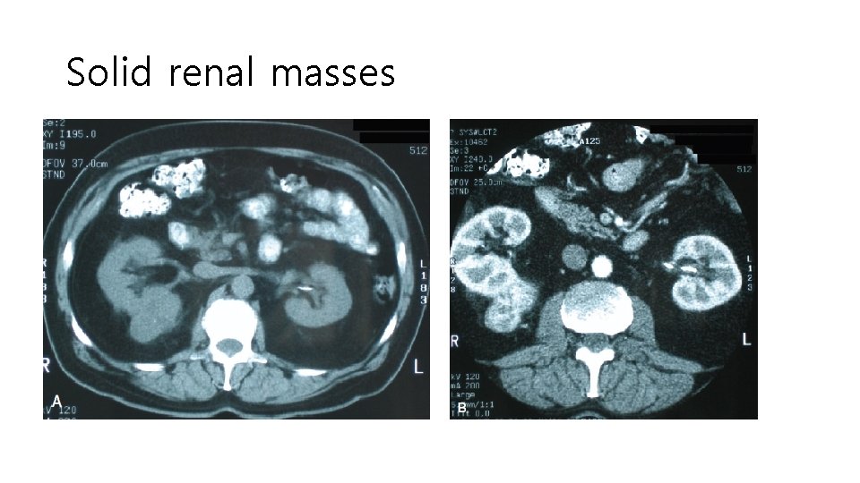 Solid renal masses 