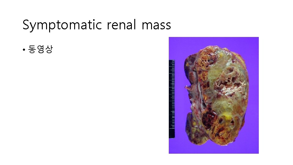 Symptomatic renal mass • 동영상 