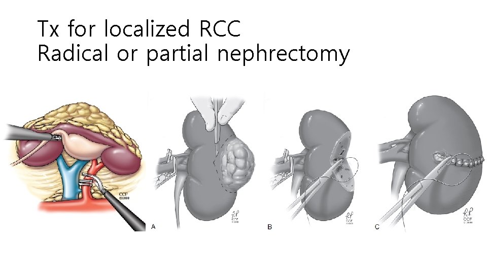 Tx for localized RCC Radical or partial nephrectomy 