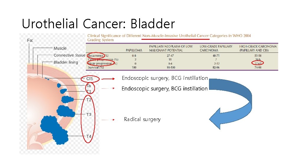 Urothelial Cancer: Bladder Endoscopic surgery, BCG instillation Radical surgery 