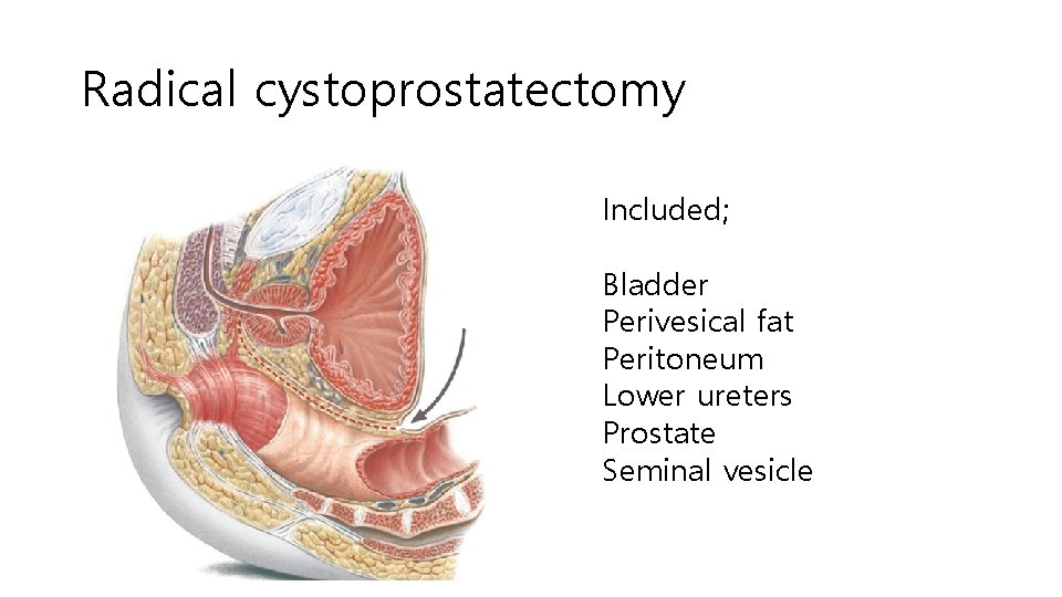 Radical cystoprostatectomy Included; Bladder Perivesical fat Peritoneum Lower ureters Prostate Seminal vesicle 