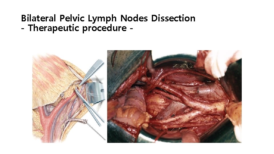 Bilateral Pelvic Lymph Nodes Dissection - Therapeutic procedure - 