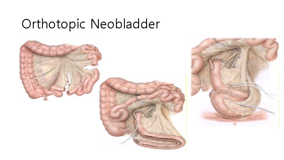 Orthotopic Neobladder 