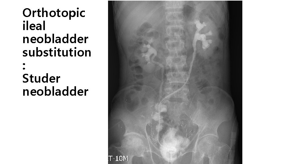 Orthotopic ileal neobladder substitution : Studer neobladder 