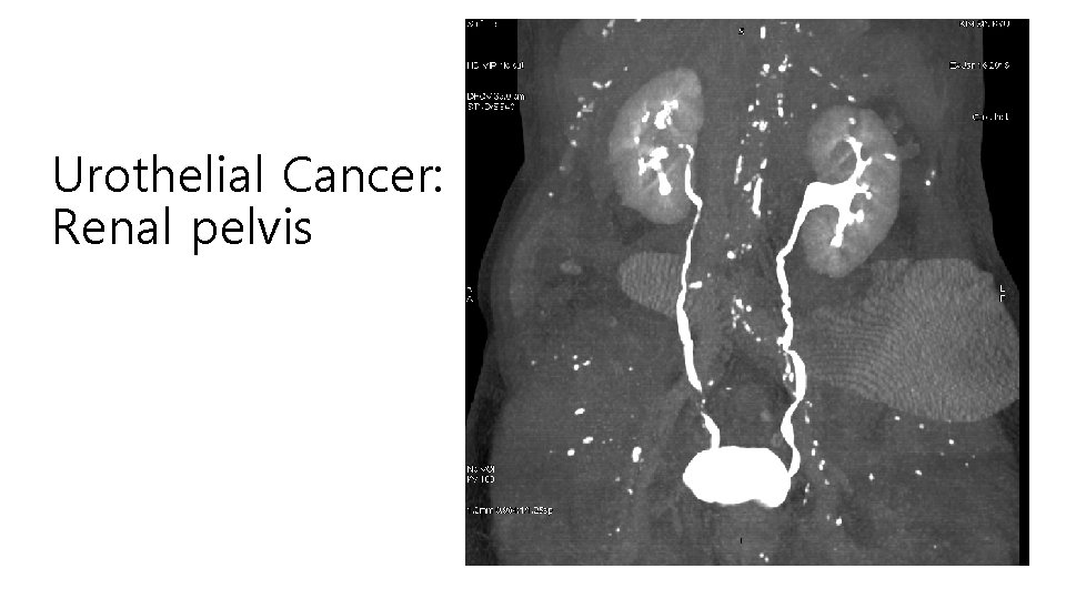 Urothelial Cancer: Renal pelvis 