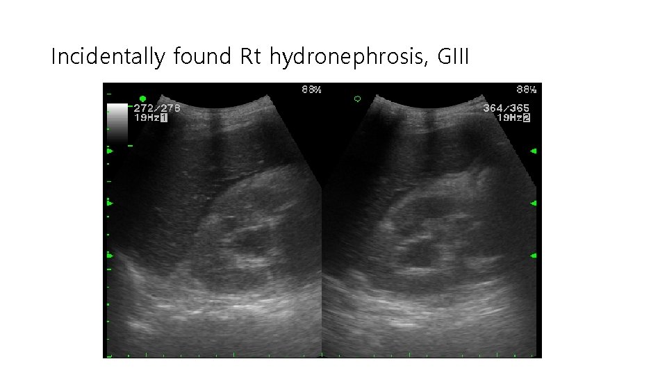 Incidentally found Rt hydronephrosis, GIII 