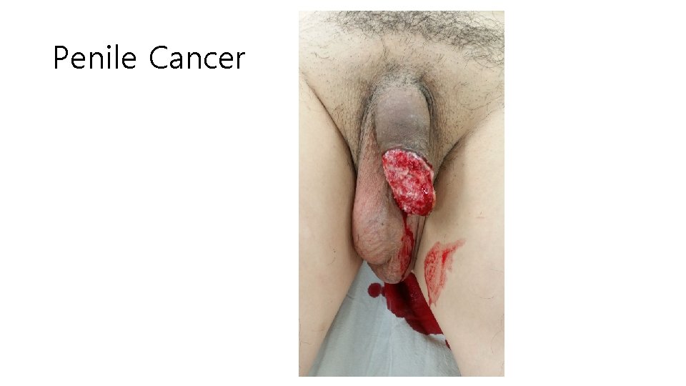 Penile Cancer 