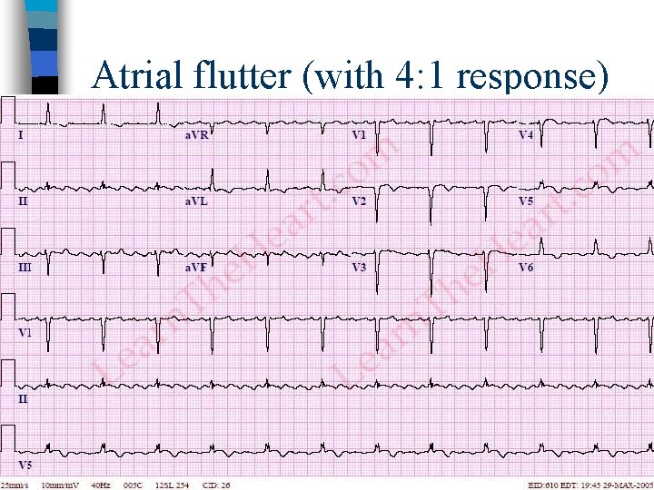 Atrial flutter (with 4: 1 response) 