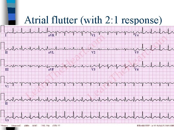 Atrial flutter (with 2: 1 response) 