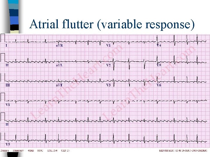 Atrial flutter (variable response) 