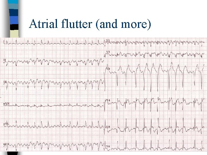 Atrial flutter (and more) 