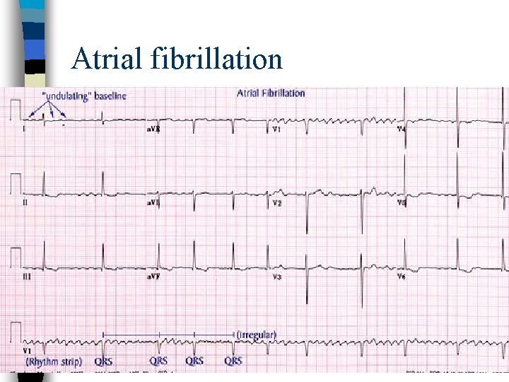 Atrial fibrillation 