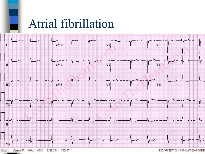 Atrial fibrillation 