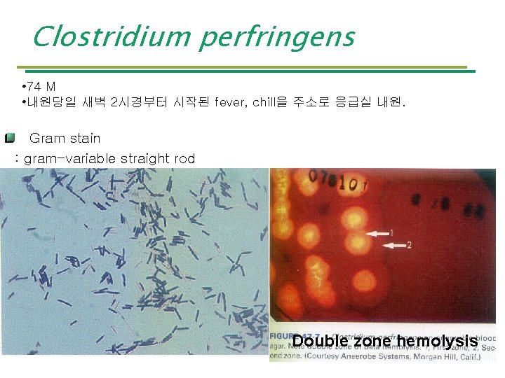 Clostridium perfringens • 74 M • 내원당일 새벽 2시경부터 시작된 fever, chill을 주소로 응급실