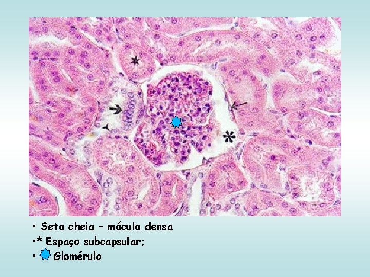  • Seta cheia – mácula densa • * Espaço subcapsular; • Glomérulo 