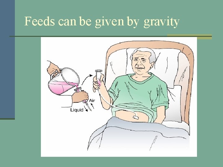 Feeds can be given by gravity 