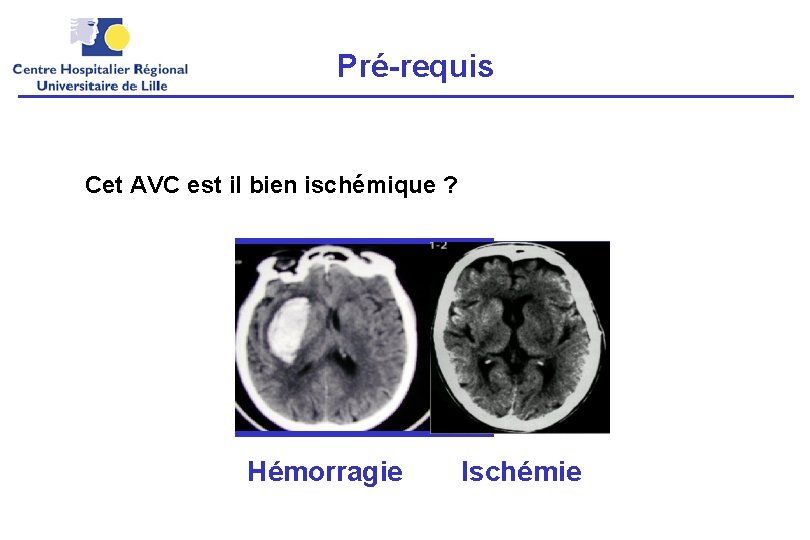 Pré-requis Cet AVC est il bien ischémique ? Hémorragie Ischémie 